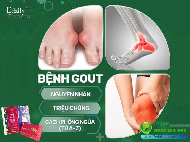 Tất tần tật về Bệnh Gout - Nguyên nhân, triệu chứng và cách phòng ngừahiệu quả