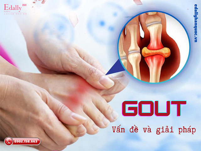 Bệnh gout và giải pháp toàn diện cho người bệnh gout