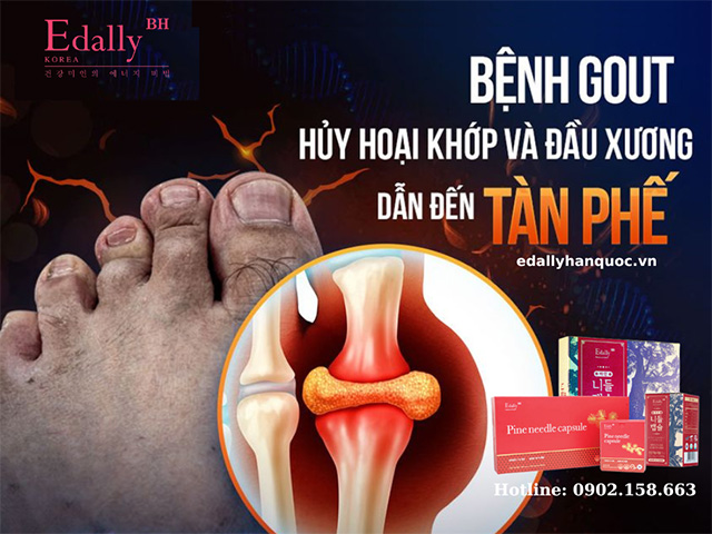 Bệnh gút gây hủy hoại xương khớp và đầu xương dẫn đến tàn phế