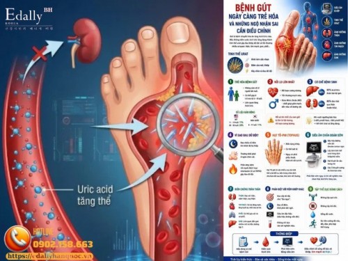 Bệnh Gút Ngày Càng Trẻ Hóa Và Những Ngộ Nhận Sai Cần Điều Chỉnh