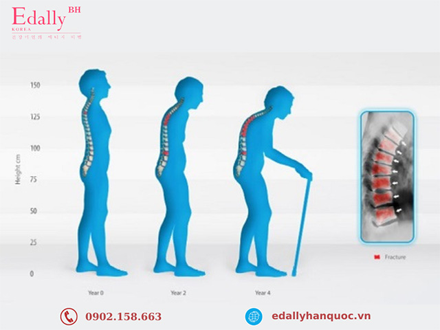 Bệnh loãng xương gây nhiều biến chứng nặng nề