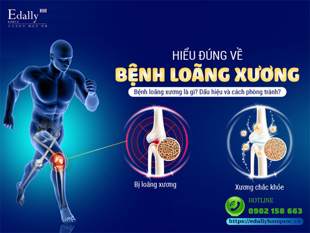 Bệnh loãng xương: Nguyên nhân, triệu chứng và cách điều trị hiệu quả