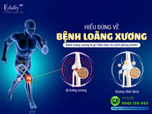 Bệnh Loãng Xương: Nguyên Nhân, Triệu Chứng Và Cách Điều Trị