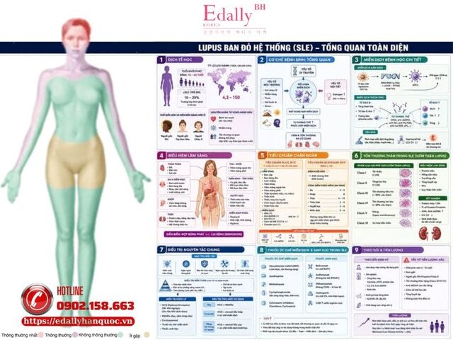 Bệnh lupus ban đỏ hệ thống (Systemic Lupus Erythematosus - SLE)