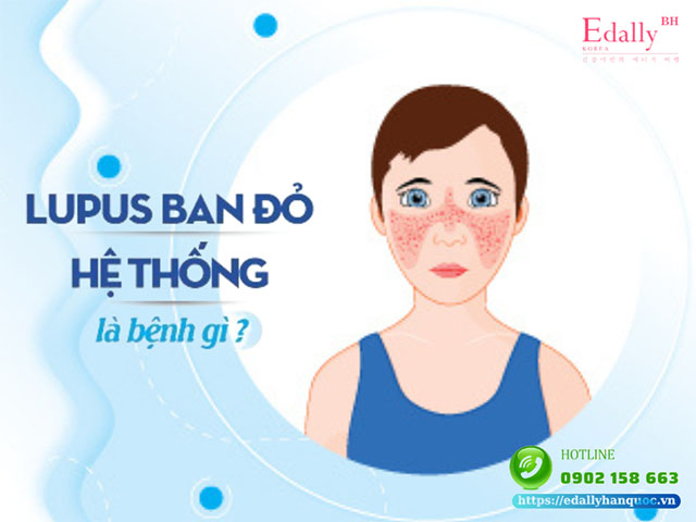 Bệnh lupus ban đỏ hệ thống và những điều cần biết để kiểm soát bệnh