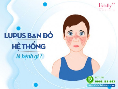 Bệnh Lupus Ban Đỏ Hệ Thống Và Những Điều Cần Biết