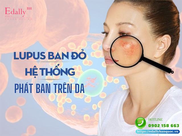 Bệnh lupus ban đỏ hệ thống và phát ban trên da