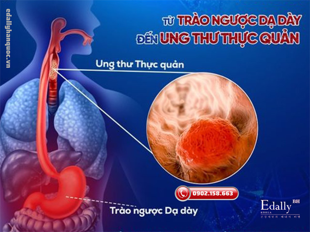 Bệnh lý đường tiêu hóa - Trào ngược dạ dày thực quản nguy hiểm thế nào?