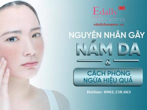 Bệnh Nám Da Mặt