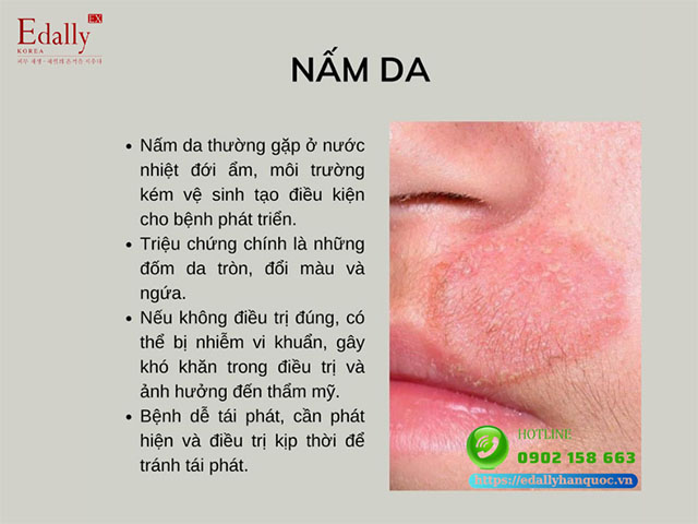 Nấm da là bệnh lý ngoài da thường gặp vào mùa hè