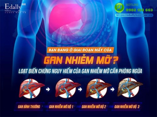 Bệnh Nhân Gan Nhiễm Mỡ Độ 1 Cần Lưu Ý Điều Gì?