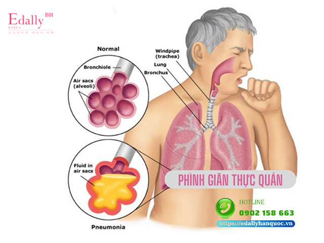 Bệnh Phình Giãn Thực Quản: Nguyên Nhân, Triệu Chứng Và Phương Pháp Điều Trị