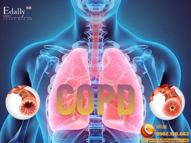 Bệnh phổi tắc nghẽn mạn tính và những điều bạn cần biết