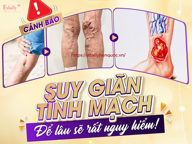 Tìm hiểu tổng quan về bệnh giãn tĩnh mạch