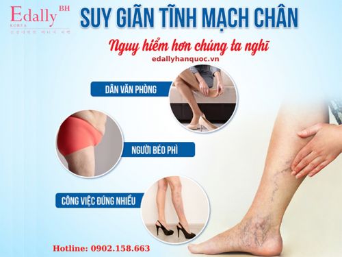 Bệnh Suy Giãn Tĩnh Mạch Và Những Điều Cần Biết