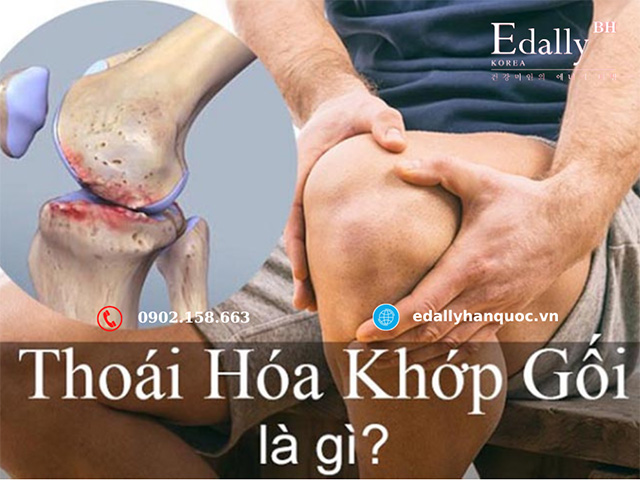 Bệnh thoái hoa khớp gối là bệnh gì?