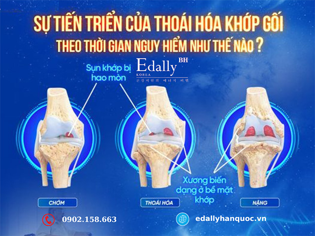 Bệnh thoái hóa khớp gối tiến triển theo thời giai nguy hiểm như thế nào?