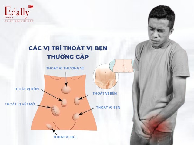 Bệnh thoát vị bẹn - Phát hiện sớm và thái độ xử trí đúng Bệnh thoát vị bẹn - Phát hiện sớm và thái độ xử trí đúng