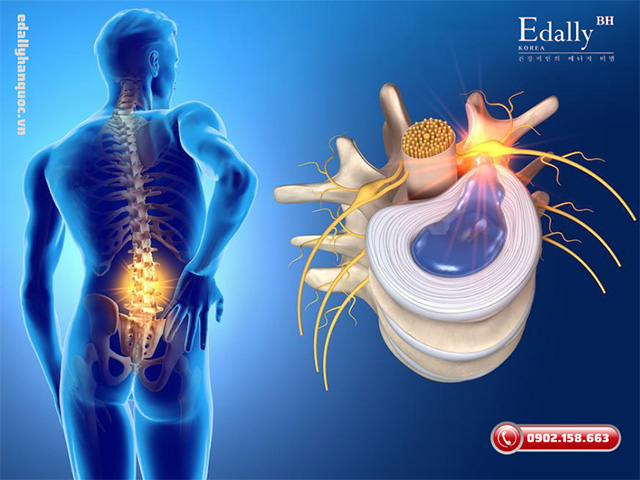 Bệnh thoát vị đĩa đệm