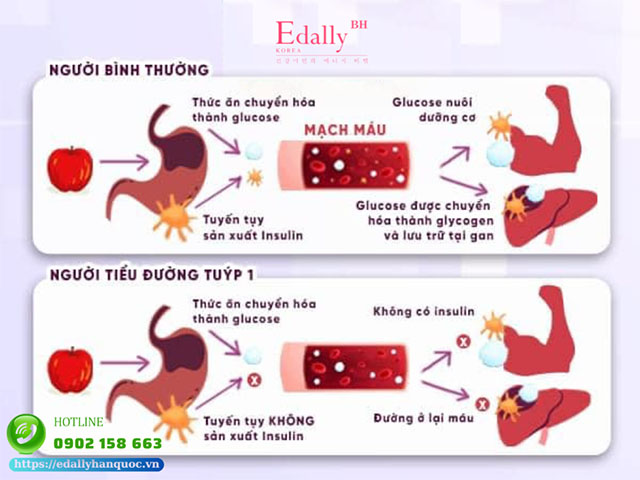 Phân biệt bệnh tiểu đường loại 1