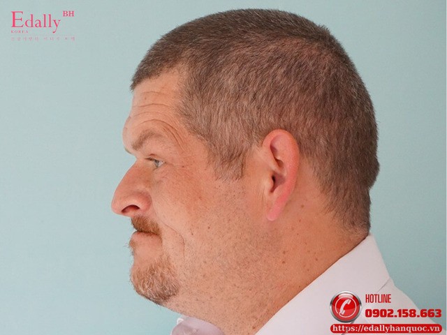 Bệnh To Đầu Chi: Đừng Chủ Quan Với Những Thay Đổi Diện Mạo Bất Thường