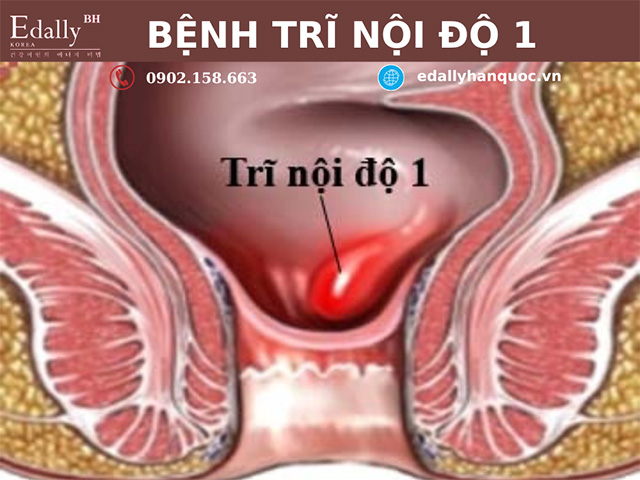 Bệnh trĩ nội độ 1