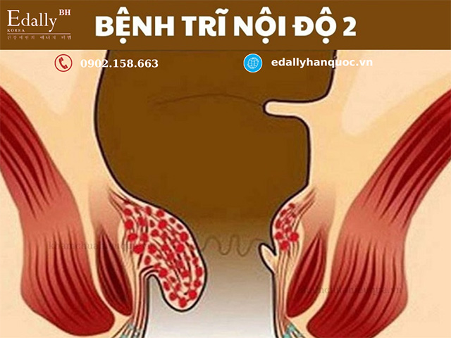 Bệnh trĩ nội độ 2