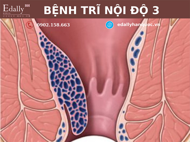 Bệnh trĩ nội độ 3