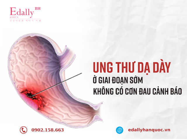 Bệnh ung thư dạ dày ở giai đoạn sớm không có dấu hiệu cảnh báo