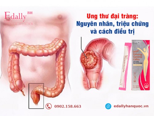 Ung Thư Đại Tràng Nguy Hiểm Thế Nào?