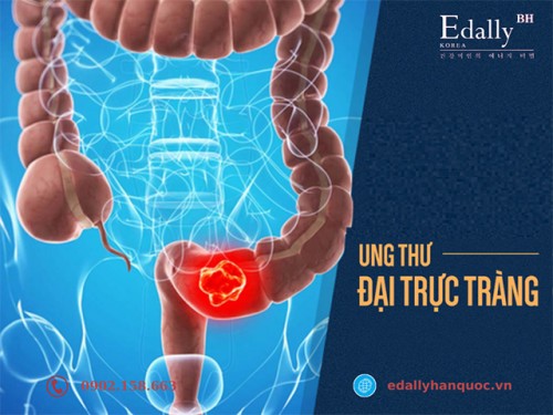 Bệnh Ung Thư Đại Trực Tràng Là Thế Nào?