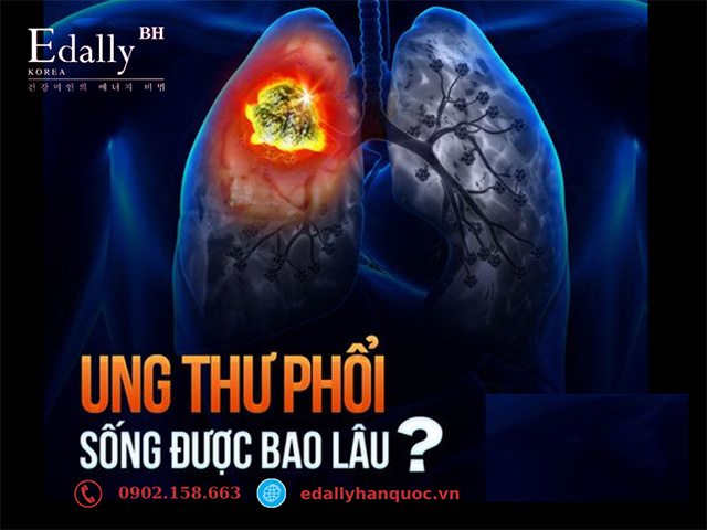 Bị mắc bệnh ung thư phổi sống được bao lâu?