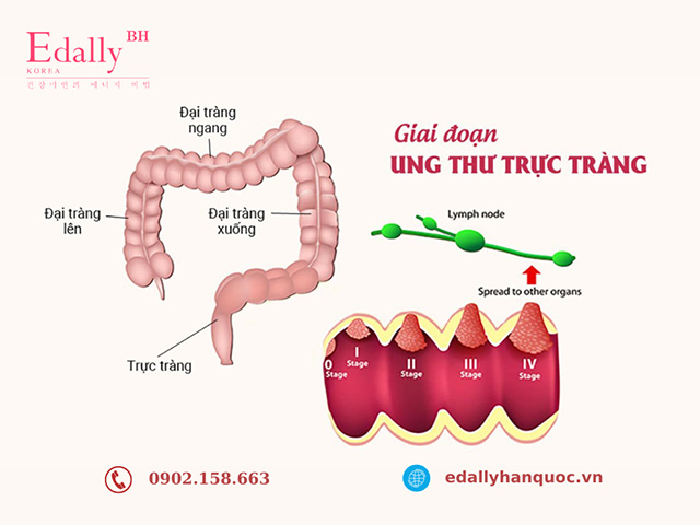 Các giai đoạn của bệnh ung thư trực tràng và tiên lượng sống sau 5 năm