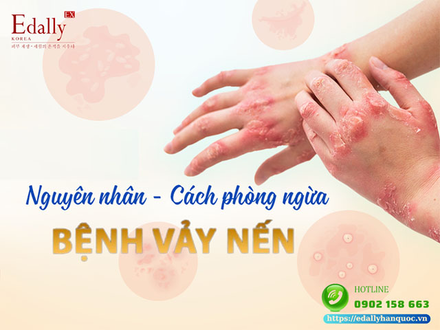 Bệnh vảy nến - Nguyên nhân, cách phòng ngừa và điều trị hiệu quả