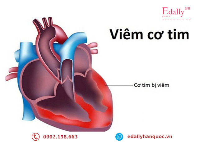 Dấu hiệu nhận biết của bệnh viêm cơ tim