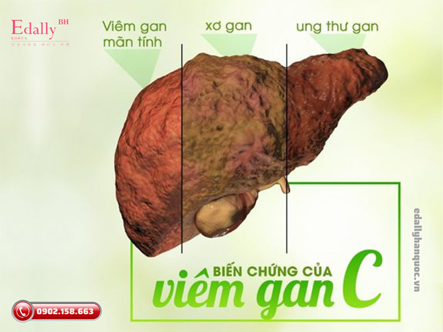 Bệnh viêm gan siêu vi C mãn tính - Kẻ hủy diệt thầm lặng không thể chủ quan