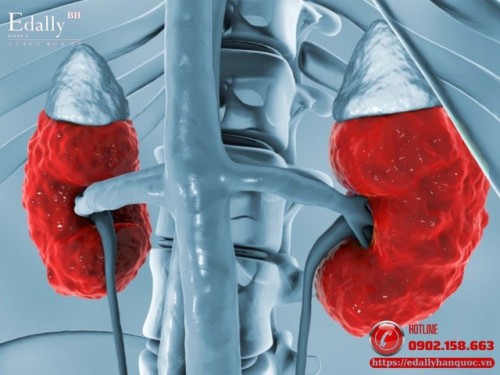 Bệnh Viêm Thận Lupus - Giải Đáp Những Câu Hỏi Thường Gặp Bệnh Viêm Thận Lupus - Giải Đáp Những Câu Hỏi Thường Gặp
