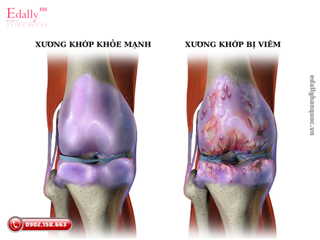 Bệnh viêm xương khớp