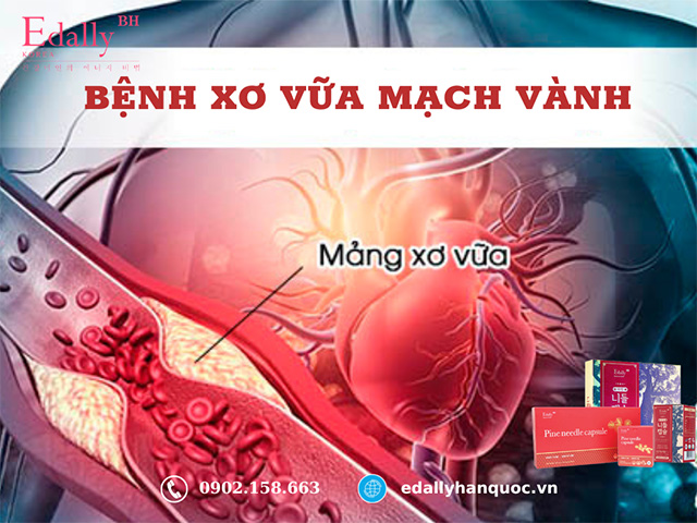 Bệnh xơ vữa động mạch vành là động mạch nuôi tim bị xơ vữa và thu hẹp lại