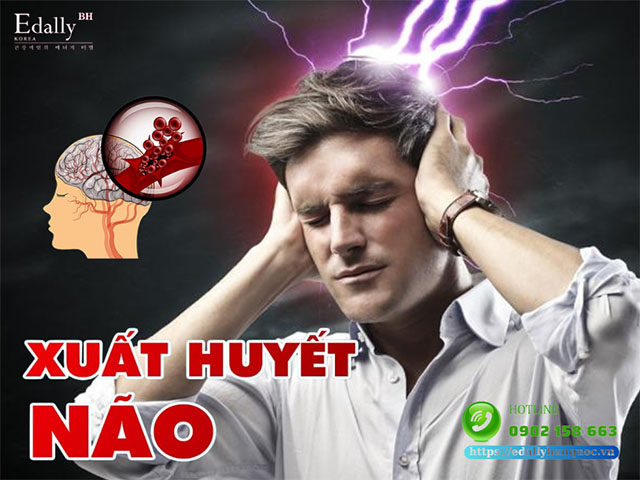 Bệnh Xuất Huyết Não: Nguyên Nhân, Triệu Chứng Và Cách Phòng Tránh