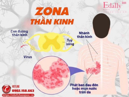Bệnh Zona Thần Kinh Ở Người Đái Tháo Đường - Có Thể Phòng Ngừa Nhưng Dễ Bị Bỏ Qua