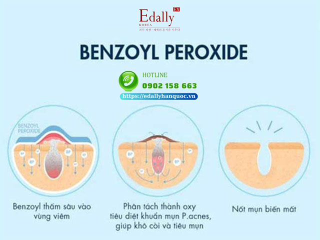 Benzoyl Peroxide là thành phần điều trị mụn trứng cá thoa tại chỗ hiệu quả