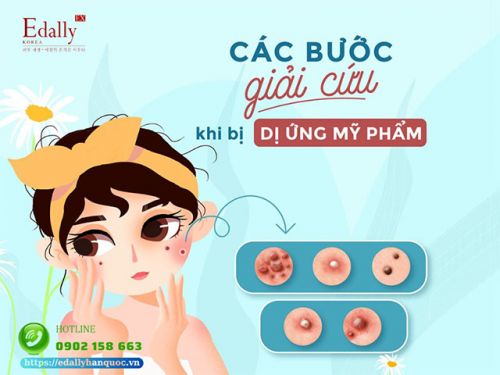 Cách Xử Lý Khi Bị Dị Ứng Mỹ Phẩm