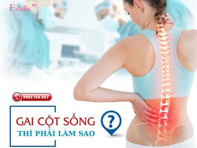 Bị bệnh gai cột sống thì phải làm sao?