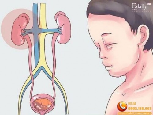 Bị Hội Chứng Thận Hư Phải Uống Medrol Và Thuốc Ức Chế Miễn Dịch Đến Bao Giờ, Có Thể Dừng Được Không?
