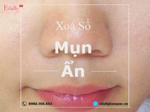 Bí Kíp Trị Mụn Ẩn Dưới Da Đơn Giản Và Hiệu Quả Nhất