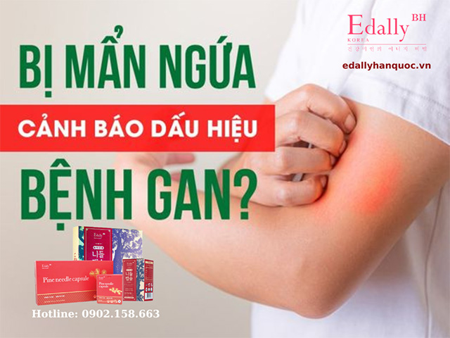 Da Bị Nổi Mẩn Đỏ Và Ngứa - Dấu Hiệu Cảnh Báo Bệnh Gan?