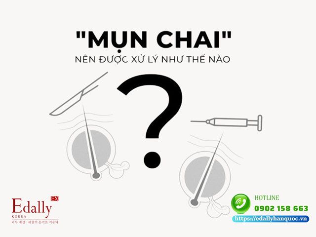 Cách xử lý mụn chai cứng dưới da và viêm như thế nào?