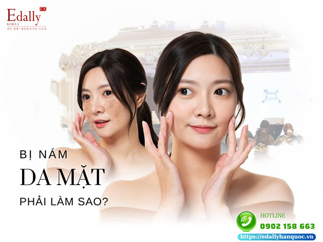 Bị nám da mặt phải làm sao để hết nám, sáng da?