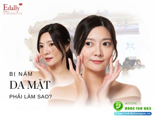 Bị Nám Da Mặt Trên Nền Da Mỏng Yếu, Nhiễm Corticoid Phải Làm Sao Để Hết Nám, Sáng Da?